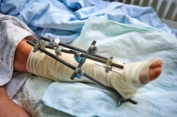 Patient recovering with an external fixator on the leg, showcasing Dr. Avinash Gadekar's expertise in treating complex polytrauma and severe bone fractures.