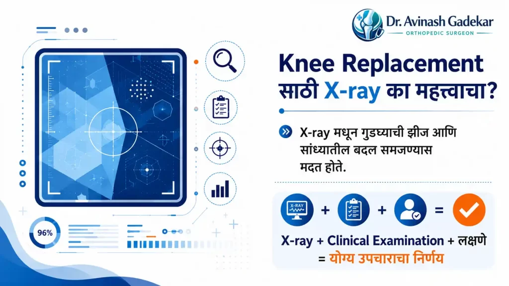 Knee Arthritis मध्ये X-ray, Clinical Examination आणि रुग्णाच्या लक्षणांच्या आधारे उपचाराचा निर्णय घेण्याची प्रक्रिया दर्शवणारे diagnostic infographic