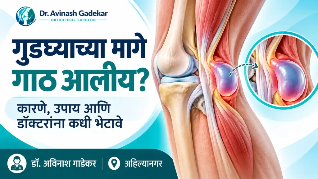 गुडघ्याच्या मागे बेकर्स सिस्टमुळे तयार होणारी द्रवाने भरलेली गाठ दर्शवणारे वैद्यकीय चित्र