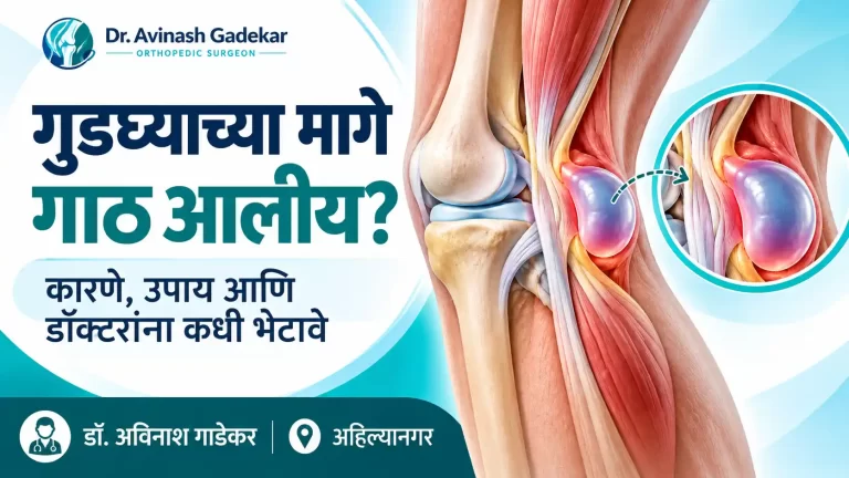 गुडघ्याच्या मागे बेकर्स सिस्टमुळे तयार होणारी द्रवाने भरलेली गाठ दर्शवणारे वैद्यकीय चित्र