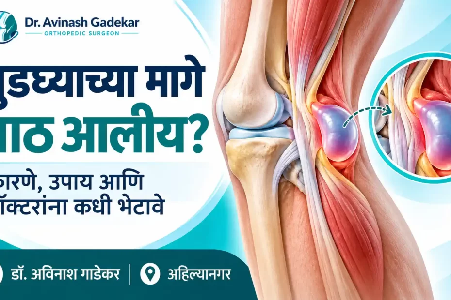 गुडघ्याच्या मागे बेकर्स सिस्टमुळे तयार होणारी द्रवाने भरलेली गाठ दर्शवणारे वैद्यकीय चित्र