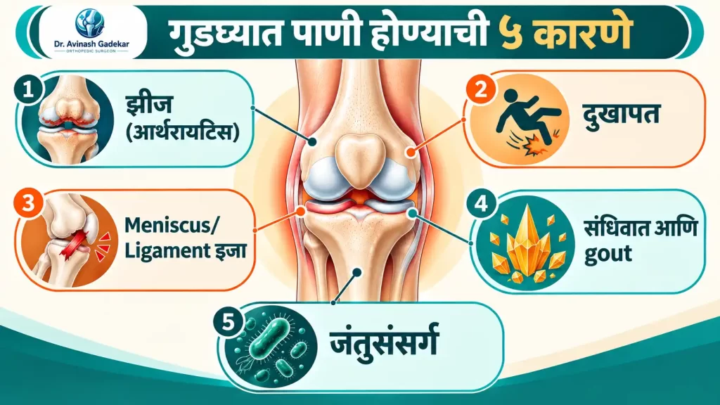गुडघ्यात पाणी होण्याची झीज, दुखापत, ligament इजा, gout आणि infection ही ५ कारणे दर्शवणारा इन्फोग्राफिक